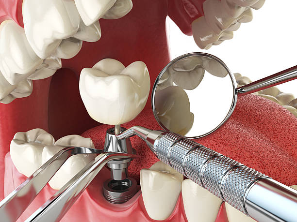 Best Emergency Dental Care for Broken or Chipped Teeth in Flomaton, AL